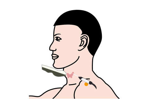 甲状腺穿刺可以做为甲状腺结节性质的诊断依据