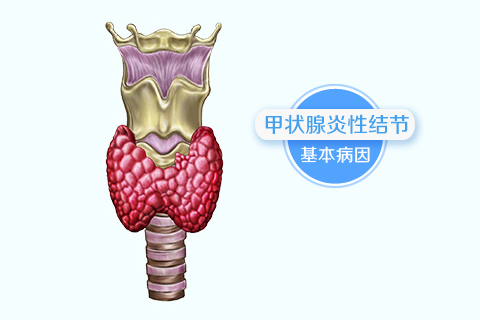 甲状腺炎性结节的基本病因