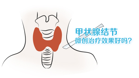 甲状腺结节微创治疗效果好吗