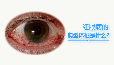 红眼病的典型体征是什么