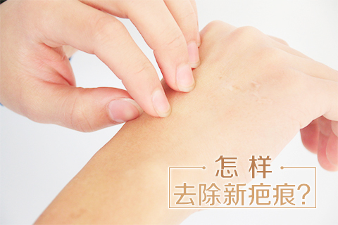 怎样去除新疤痕