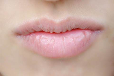 患有干燥综合征的患者会出现口干、口腔黏膜发黏、龋齿、口腔溃疡、口唇干裂等症状