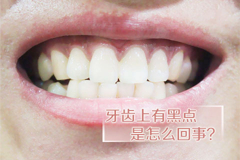 牙齿上有黑点是怎么回事