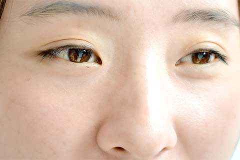 雀斑具有一定的遗传性，好发于面部的两颊和鼻部，女性比较多见