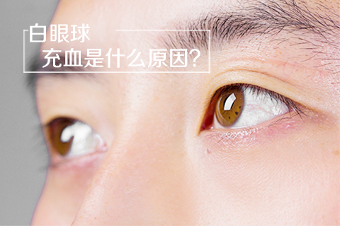 白眼球充血是什么原因