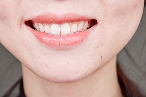 门牙就是位于上齿正前方的两颗呈铲状的牙齿