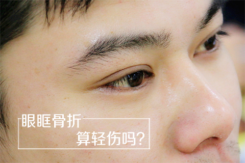 眼眶骨折算轻伤吗