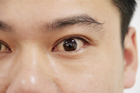 眼睛充血是眼科疾病常见的症状之一