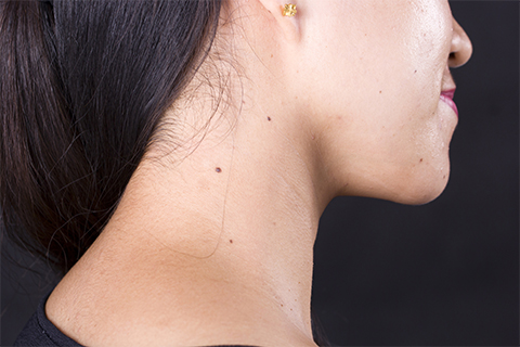 痣根据对人体的影响可以分为良性痣和恶性痣 痣根据对人体的影响可以分为良性痣和恶性痣