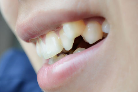 牙结石是由于牙齿清洁不当引起的 牙结石是由于牙齿清洁不当引起的