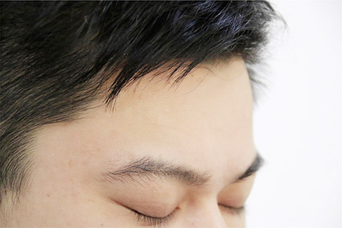 引起额头上长痘痘的原因有很多