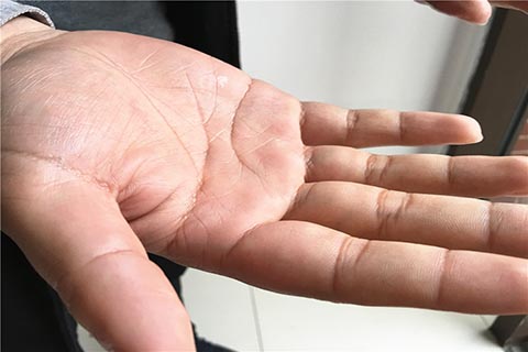 手上起小水泡是什么原因