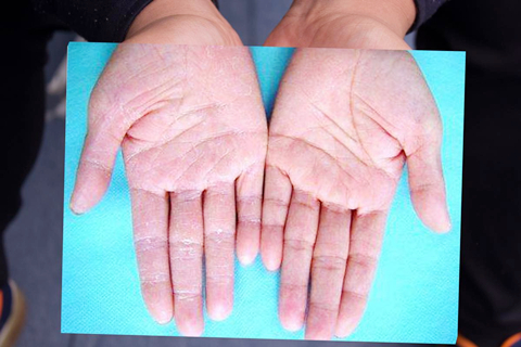事实上大部分的手指脱皮跟季节都是有关系的