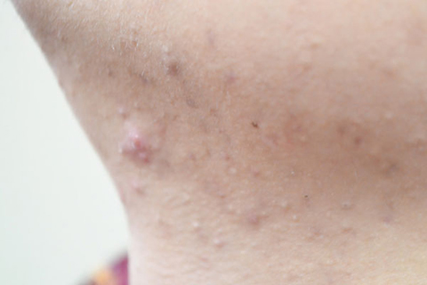 长痘在生活中是比较常见的事情