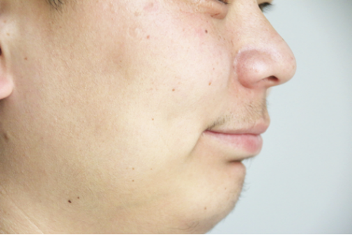 面瘫有可能是脑血管疾病、颅脑肿瘤、脑外伤、炎症导致的中枢神经炎引起的