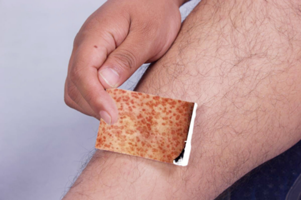 梅毒，这是一种因为梅毒螺旋体引起的慢性传染性疾病