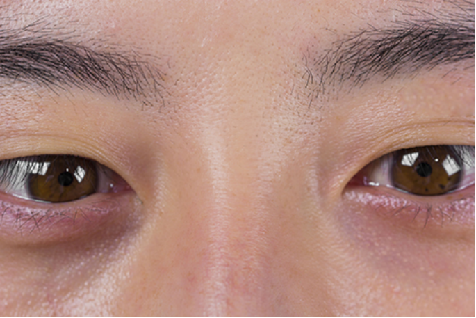 怎么看自己是不是斗鸡眼