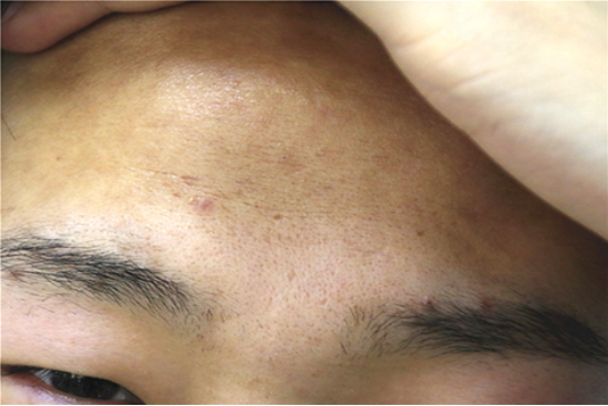 额头起小疙瘩怎么回事