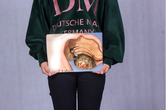 卵巢囊肿会消失吗