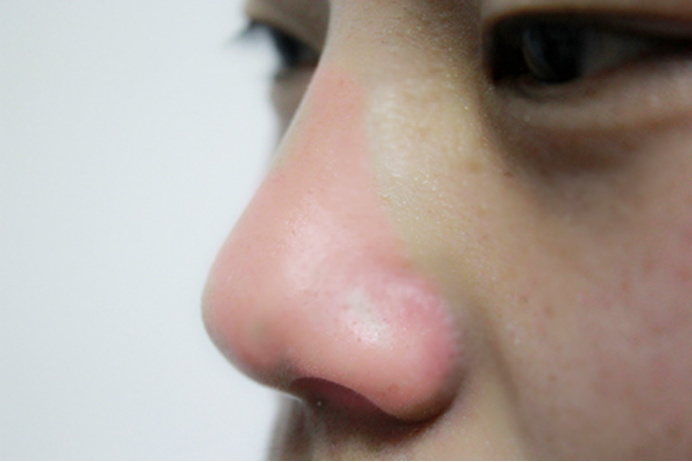 如何预防鼻塞咳嗽