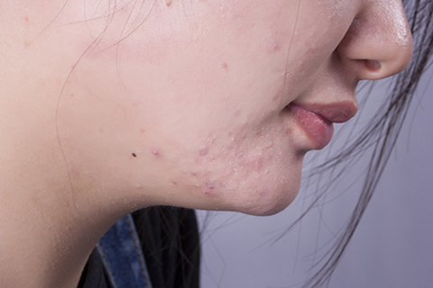 怀孕脸上长痘是男孩吗