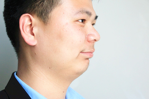 白色糠疹听着好像不太熟悉，其实在生活中是很常见的