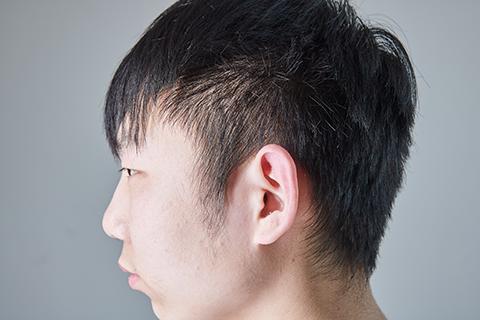 外耳道炎一般是由于外耳道出现的伤口受到细菌的感染，产生的红肿、肿块，脓液的现象