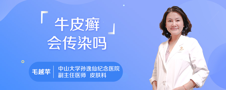 牛皮癣会传染吗
