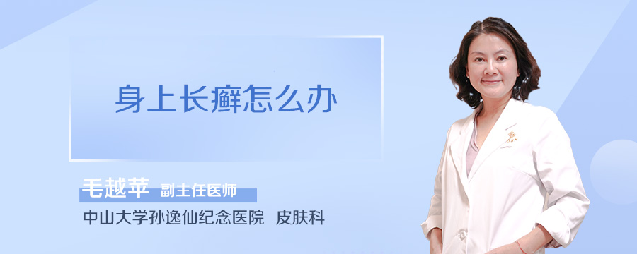 身上长癣怎么办