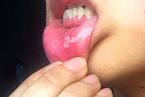 口腔溃疡的表现症状图片