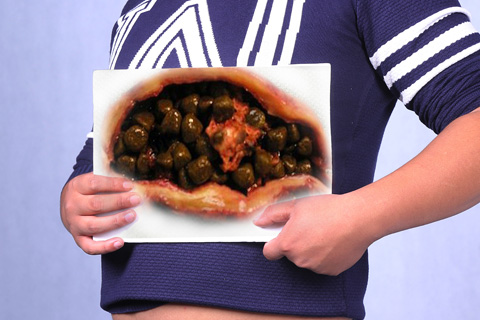 胆结石最佳治疗方法是什么 胆结石最佳治疗方法是什么