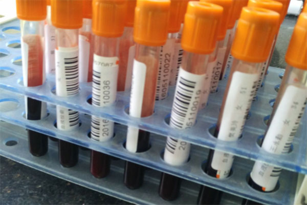 血脂高会对身体造成一定的危害，并且如果不及时控制的话，还会引发一些疾病