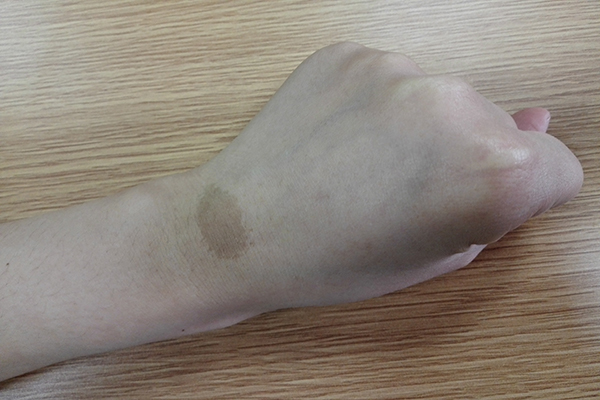 中国中医科学院西苑医院皮肤科刘青云医生_手上长斑怎么去除