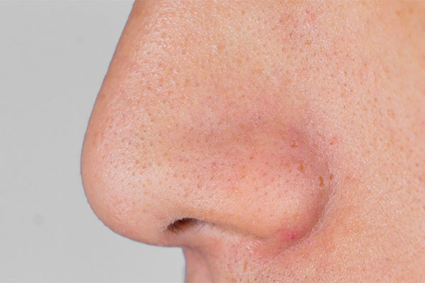 沈阳医学院附属第二医院皮肤科张英志医生_毛孔黑头怎么彻底清除