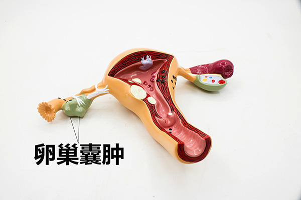 对于育龄女性来说，患上卵巢囊肿要重视，要尽早去医院治疗