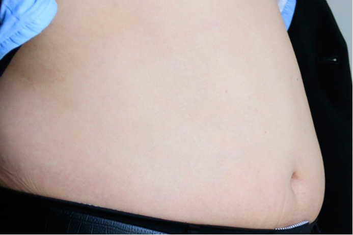 可以通过饮食调节配合运动长期坚持锻炼