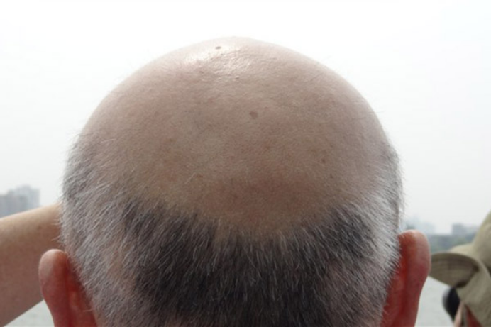 生发吃什么比较好