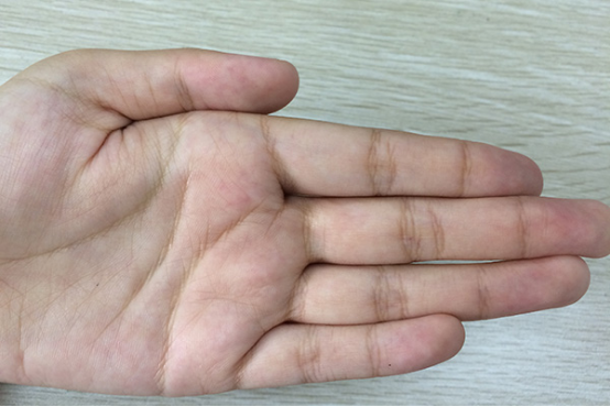 手指脱皮是缺什么维生素