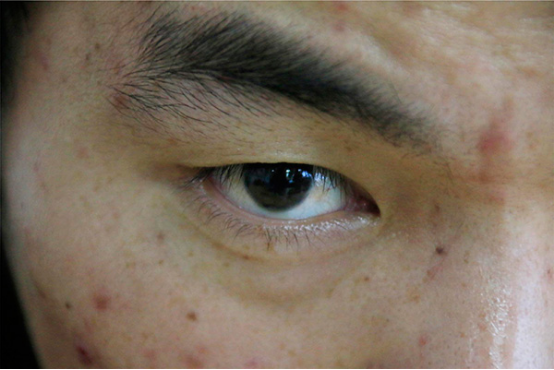 左脸颊长痘的原因 左脸颊长痘的原因