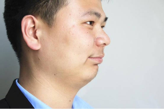 诱发黄褐斑的原因有很多，正确的治疗可以让黄褐斑变淡，或者是消失，但是无法保证黄褐斑不会复发，所以一般不会用根治来形容治疗的效果。