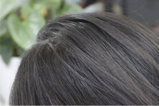 头皮屑一块一块的怎么回事