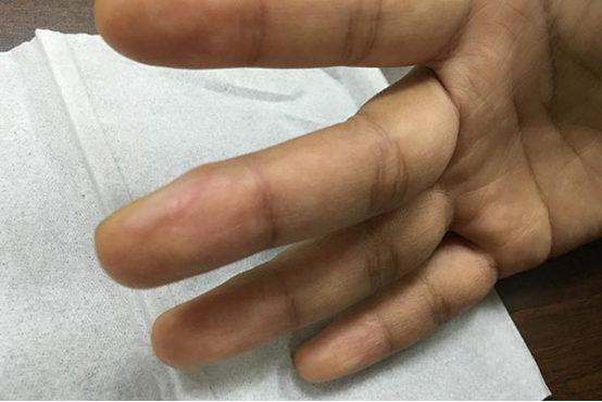 手指缝里长水泡很痒是什么原因