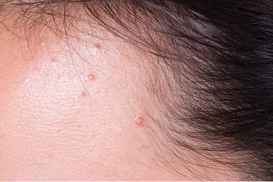 发际线长痘是什么原因