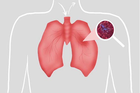 肺结节最怕的食物