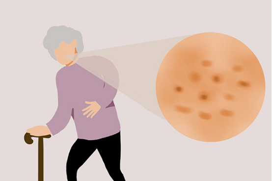 临床上,主要采用冷冻的方式来进行治疗 临床上,主要采用冷冻的方式来进行治疗