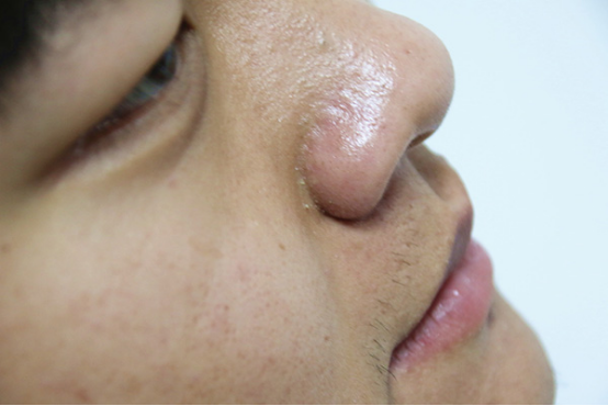 脂溢性皮炎是能根治的一种疾病,只要方法对症是可以完全治好的 脂溢性皮炎是能根治的一种疾病,只要方法对症是可以完全治好的