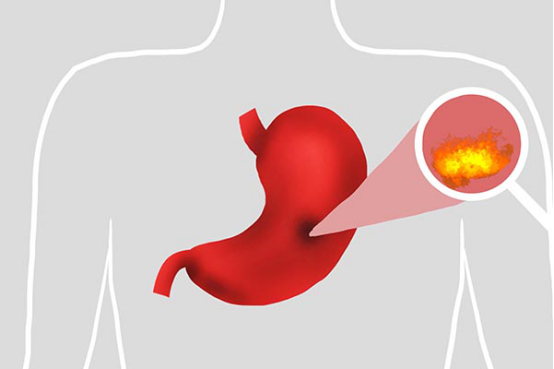 首先需要对自己的饮食习惯做出改善，少吃脂肪多、高能量的食物，少喝浓茶、咖啡，戒烟戒酒，可以改善胃烧心的症状