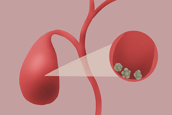 有的结石是比较小的, 一般通过多喝水或者是多吃一些能够帮助散结的食物就可以自己排出去了。 有的结石是比较小的, 一般通过多喝水或者是多吃一些能够帮助散结的食物就可以自己排出去了。