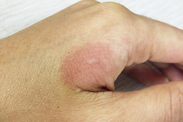 建议大家可以最好立即将手放在水龙头底下用凉水冲洗，或者是将手直接浸泡在凉水里面。