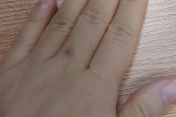 手麻的五种征兆分别是酒精中毒、颈椎病、糖尿病、末梢神经炎以及糖尿病。